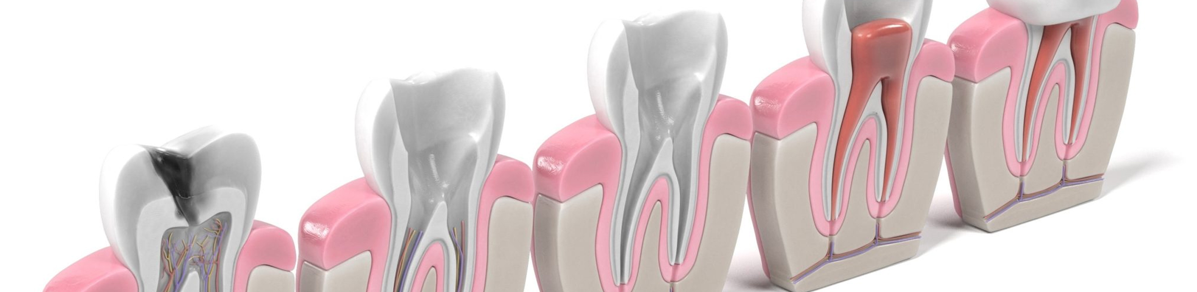 Root Canal Find Dentist Orthodontist Auckland