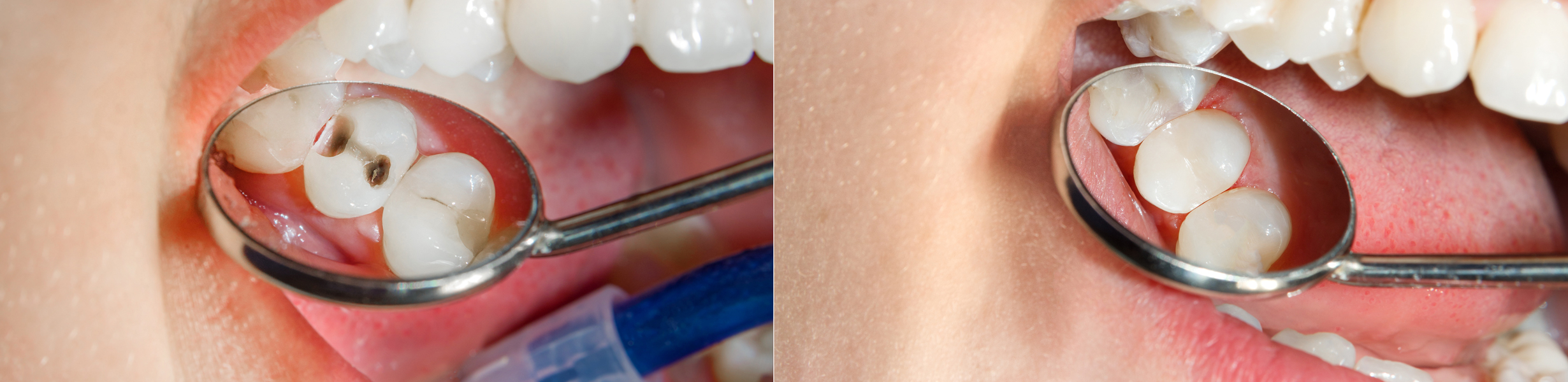 Tooth Filling Dental Fillings The Tooth Company