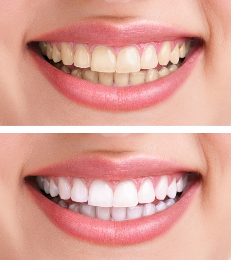 Dental Veneers Veneer Teeth The Tooth Company