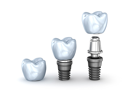Tooth Company Dental Implants